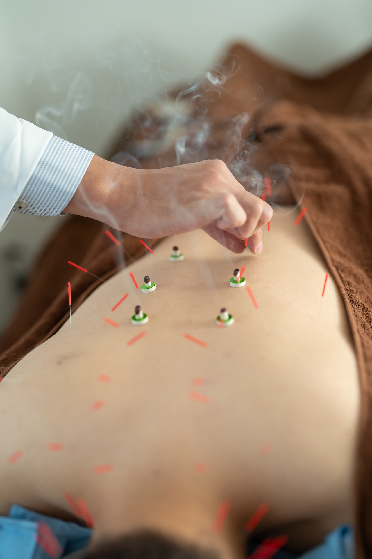 頚椎症、五十肩、頭痛、肩こり、腰痛、膝痛、不眠、倦怠感、生理痛、坐骨神経痛、寝違え、ぎっくり腰、脳卒中後遺症、スポーツ障害、美容、小顔、美肌、肌荒れ、ニキビ、シミ、シワ、たるみ、等のお悩みを抱える患者様が渋谷駅近くのreCare道玄坂鍼灸院の施術内容を視覚的に理解できるように施術に用いる痛みの出ない極細鍼と火傷の心配がないお灸を施術している写真