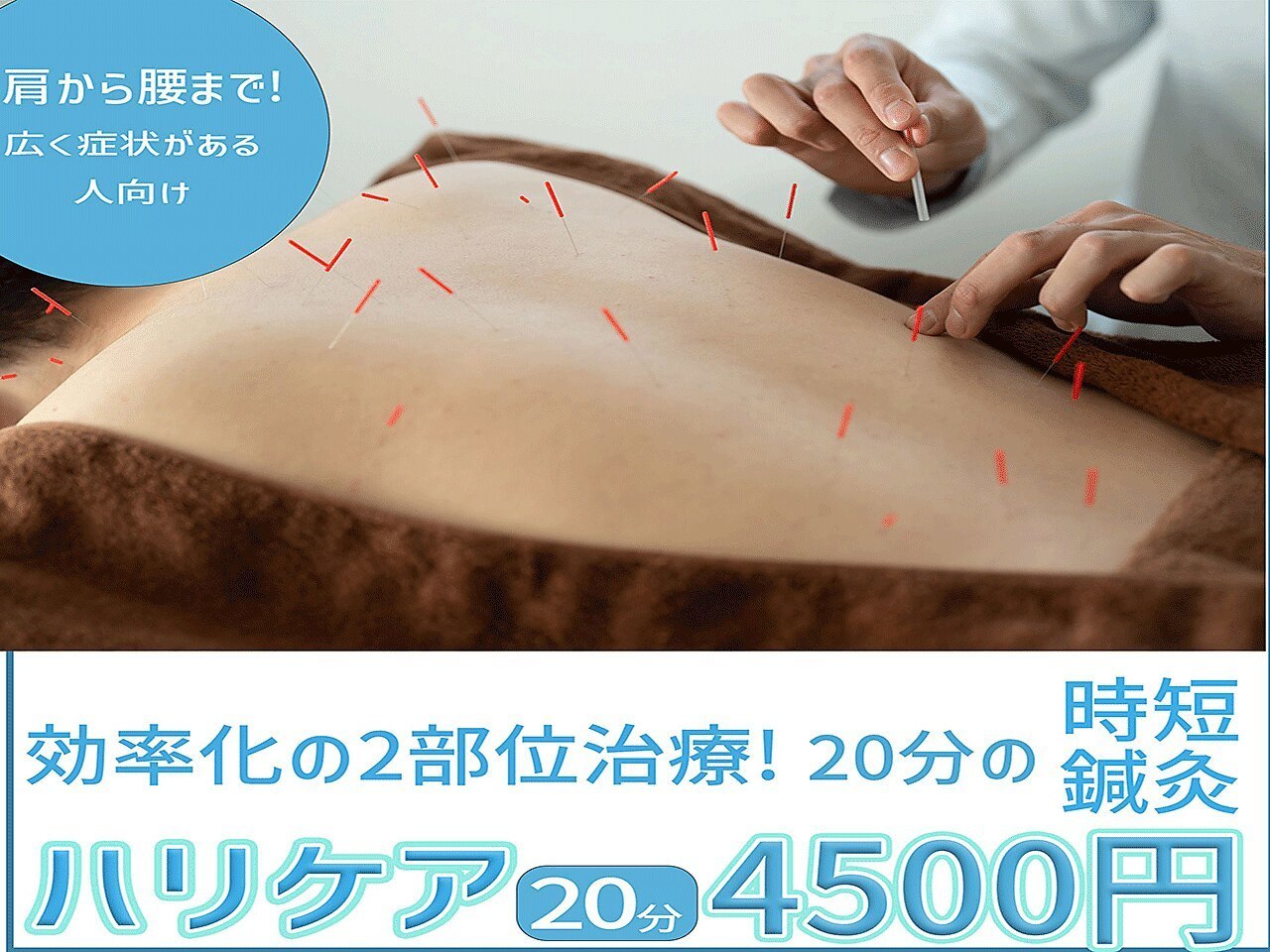 頚椎症、五十肩、頭痛、肩こり、腰痛、膝痛、不眠、倦怠感、生理痛、坐骨神経痛、寝違え、ぎっくり腰、等の原因の部位に直接アプローチするためすぐに効果を実感して頂ける渋谷駅近くにあるreCare道玄坂鍼灸院にて提供しているハリケアのイメージ