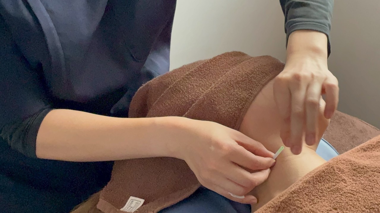 頚椎症、五十肩、頭痛、肩こり、腰痛、膝痛、不眠、倦怠感、生理痛、坐骨神経痛、寝違え、ぎっくり腰、等への施術が最短10分から受けられるため、１日2回、隙間時間でも受けられることを可能にした渋谷駅近くにあるreCare道玄坂鍼灸院にて提供しているハリケアのイメージ